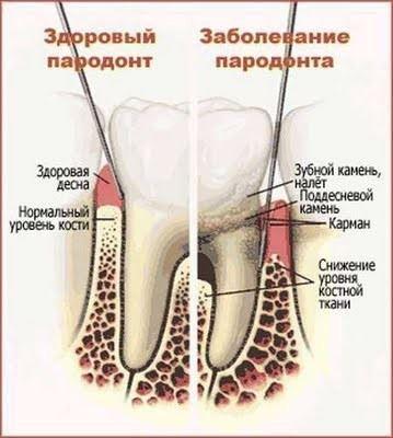 Пародонтоз зуба в Ниднем Новгороде