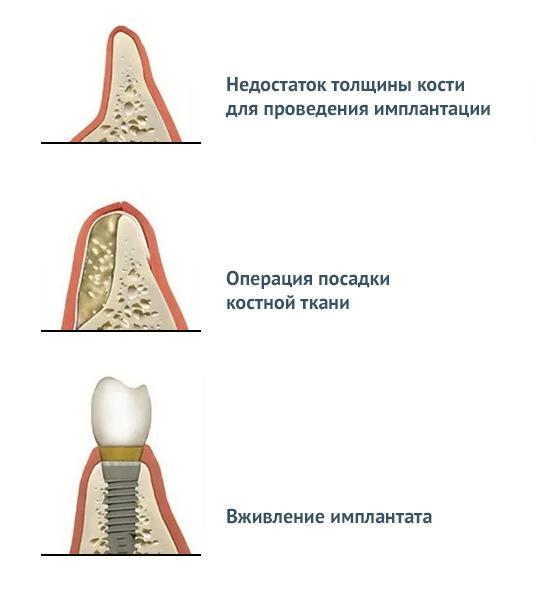 Костная пластика зубов