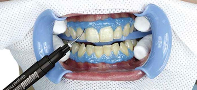 Подготовка зубов к отбеливанию